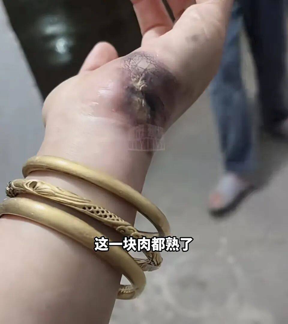 一瞬間手被燒熟，金手鐲被電碎！女子給電動車充電，不慎碰到充電口受傷:中航光電科技股份有限公司
